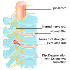 Disc Prolapse Herniation