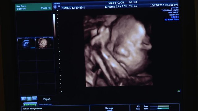 Video out put from a 4D ultrasound combined with graphics