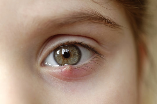 Close-up of a child's eye stye. Ophthalmic hordeolum disease