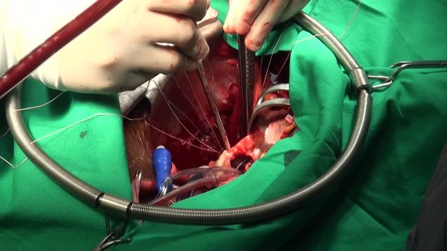 Heart valve surgery. Doctors perform surgery on open heart 