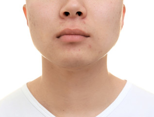 Handsome young man with problem skin on white background, closeup