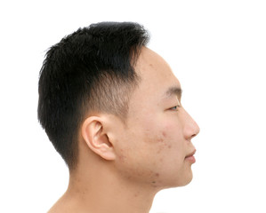 Fototapeta premium Young Asian man with problem skin on white background