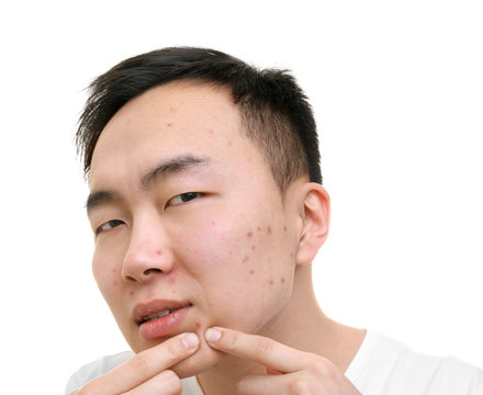 Young Asian man popping pimples, on white background