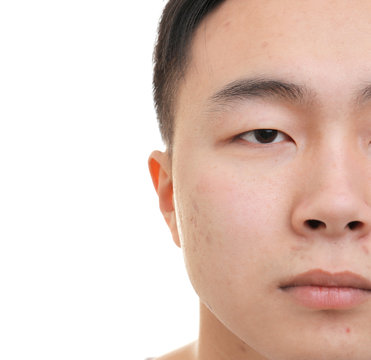 Young Asian man with problem skin on white background, closeup