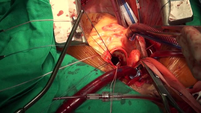 Heart valve surgery. Doctors perform surgery on open heart 