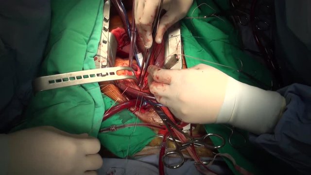 Heart valve surgery. Doctors perform surgery on open heart 