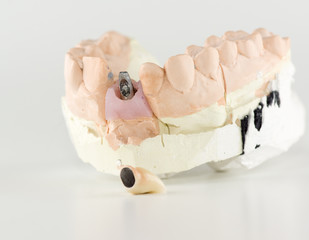 new dentures on a white background