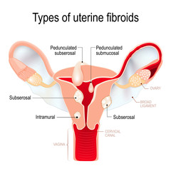 types of uterine fibroids: subserosal, intramural, submucosal, and pedunculated fibroids.