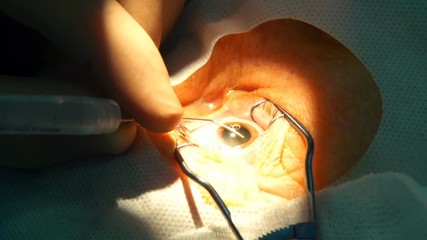 anesthesia before laser surgery vision correction, ophthalmology operation, Surgeon's hands in gloves performing laser eye vision correction correction, surgery eye, Cataract surgery