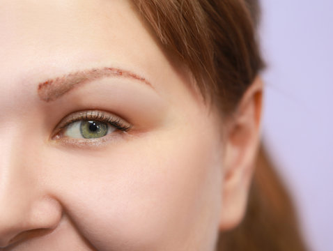 Woman in process of eyebrow tattoo removal