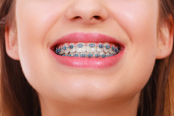 Closeup of woman teeth with braces