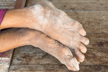 old dirty feet