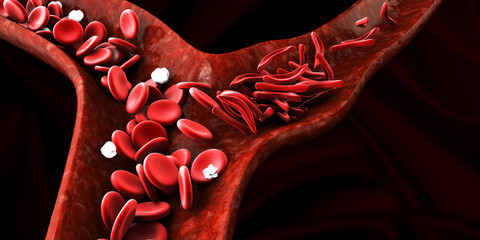 Sickle cell anemia, showing blood vessel with normal and deformated crescent. 3D illustration - obrazy, fototapety, plakaty