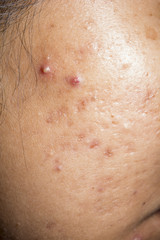 Fototapeta premium closeup for acne on face