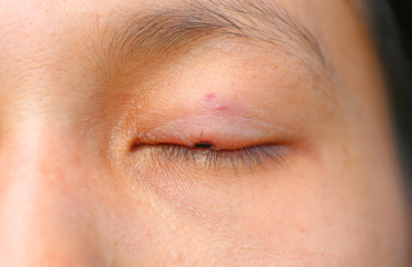 Fototapeta na wymiar The wound medicine at eyelid, After removal fleck or birthmark by laser.