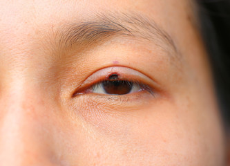 Fototapeta na wymiar The wound medicine at eyelid, After removal fleck or birthmark by laser.