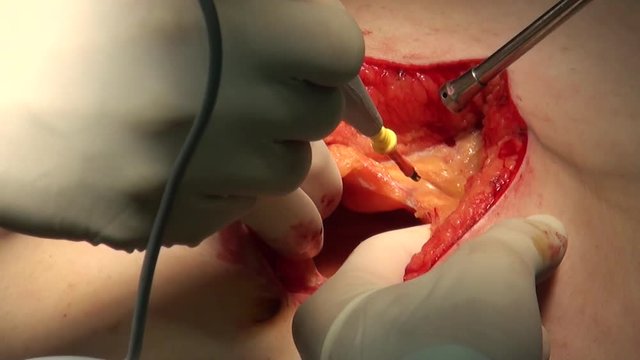 Total gastrectomy. Surgery for stomach cancer, incision on stomach
