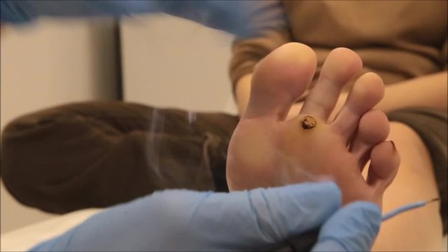 Dermatologist surgeon operates to remove plantar wart under foot using electro scalpel	