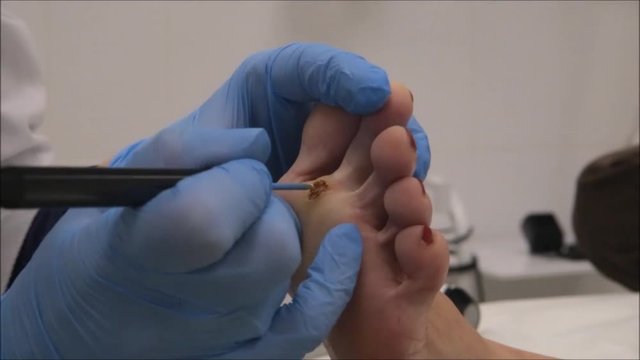 Dermatologist surgeon to cauterize wound after surgical operation of plantar wart removal using electrocautery tool