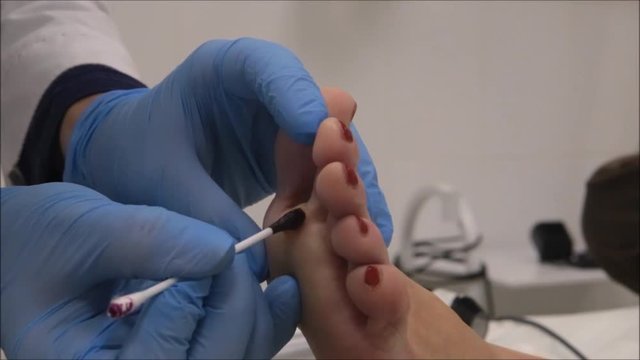 Dermatologist surgeon disinfects the wound after plantar wart removal