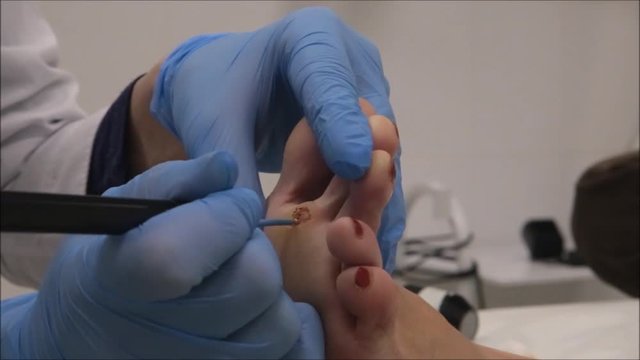 Dermatologist surgeon to cauterize wound after surgical operation of plantar wart removal using electrocautery instrument