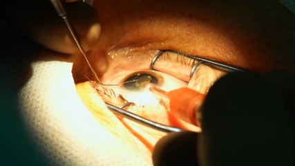 anesthesia before laser surgery vision correction, ophthalmology operation, Surgeon's hands in gloves performing laser eye vision correction correction, surgery eye, Cataract surgery