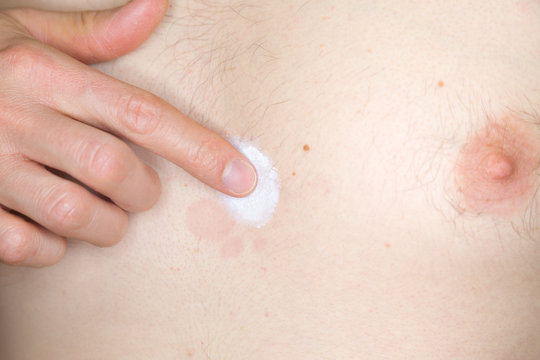 Brust eines jungen Mannes mit Hautpilz