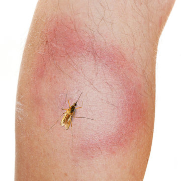 An Erythema Migrans rash often seen in the early stage of Lyme disease. It can appear after a tick or mosquito bite. It is an actual skin infection with the Lyme bacteria, Borrelia burgdorferi.