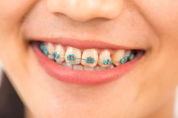 Beautiful young woman with brackets on teeth close up