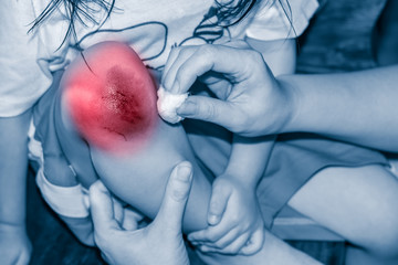 Fototapeta premium Child injured. Closeup wound on child knee. Children have been an accident.