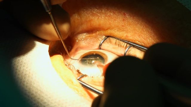 anesthesia before laser surgery vision correction, ophthalmology operation, Surgeon's hands in gloves performing laser eye vision correction correction, surgery eye, Cataract surgery