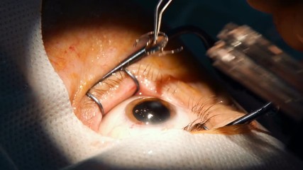 anesthesia before laser surgery vision correction, ophthalmology operation, Surgeon's hands in gloves performing laser eye vision correction correction, surgery eye, Cataract surgery