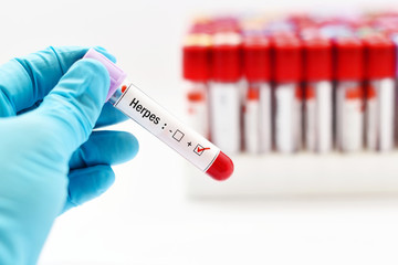 Fototapeta premium Blood sample positive with herpes virus