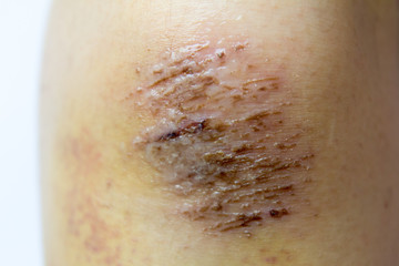 Fototapeta premium Closed up of red scab injury on woman knee background