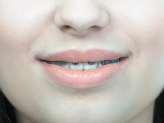 Naklejka premium Woman showing her teeth with braces