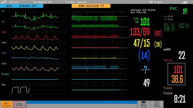 ICU medical monitor showing sick patient's condition, hospital care, treatment. Medical ICU monitor with patient's vital signs