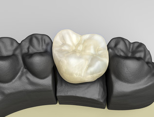 keramikkrone 3d © MStock