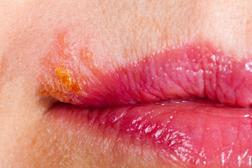 Herpes on the lip close up macro