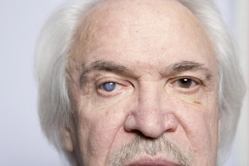 Eye disease treatment