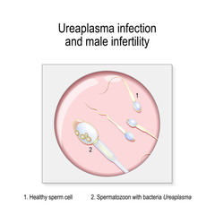 Ureaplasma infection and male infertility.