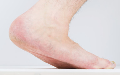 Flatfoot on the male foot with signs of fungal disease.