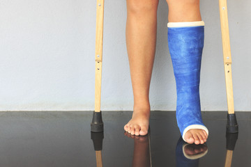 broken leg in a plaster cast with soft-focus in the background. over light