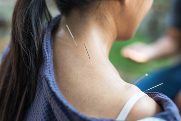 Acupuncture