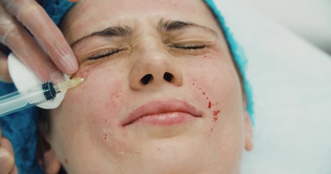 4k Close-up of a young woman having botox injection in the beauty salon