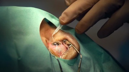 anesthesia before laser surgery vision correction, ophthalmology operation, Surgeon's hands in gloves performing laser eye vision correction correction, surgery eye, Cataract surgery