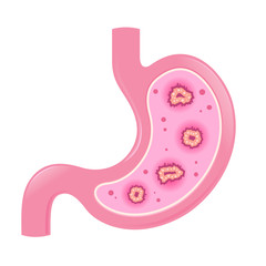 Stomach Intestine With Virus Or Bacteria Inside