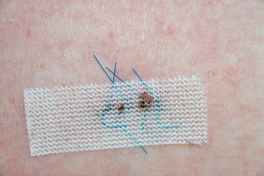 Frische, gen&auml;hte Narbe nach der Entfernung eines tiefgehenden Leberflecks/ Muttermals/ Melanoms/ von Hautkrebs mit Pflaster zur besseren Wundheilung