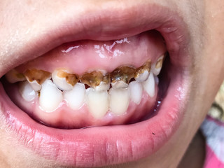 Obraz premium Little child with broken and decay teeth