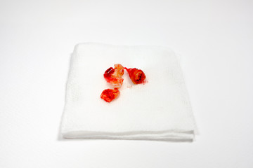 Extraction of decayed tooth with bloody gauze pad on white background. (Dental treatment)