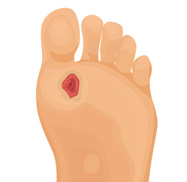 Diabetic Ulcer On Human Foot Vector Illustration